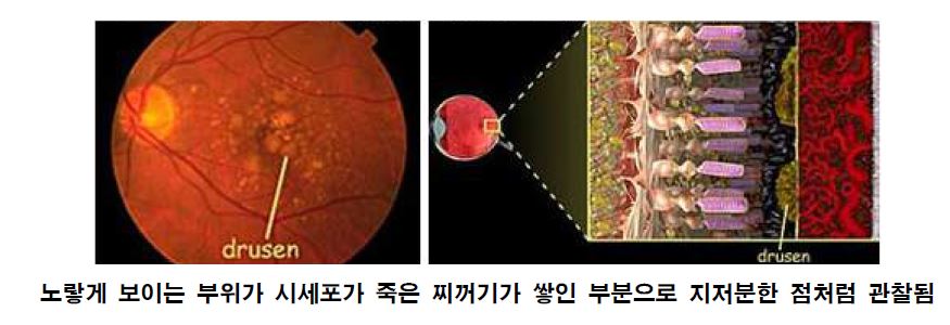 그림 8. 건성 황반변성