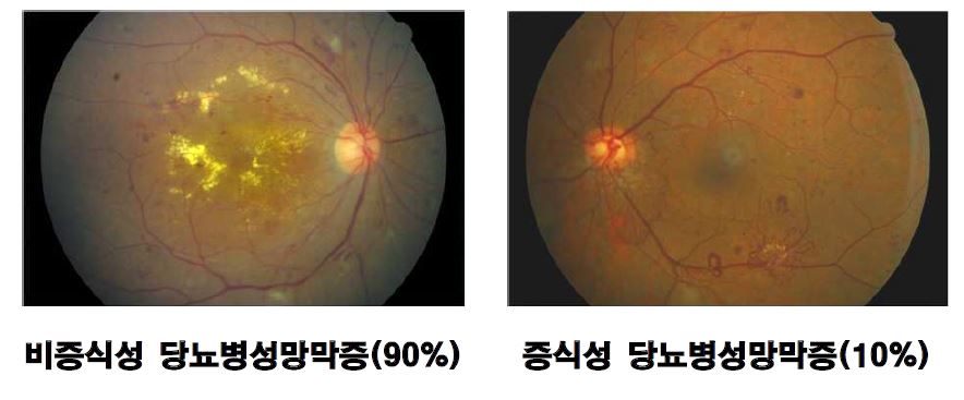 그림 11. 당뇨병성망막증의 종류