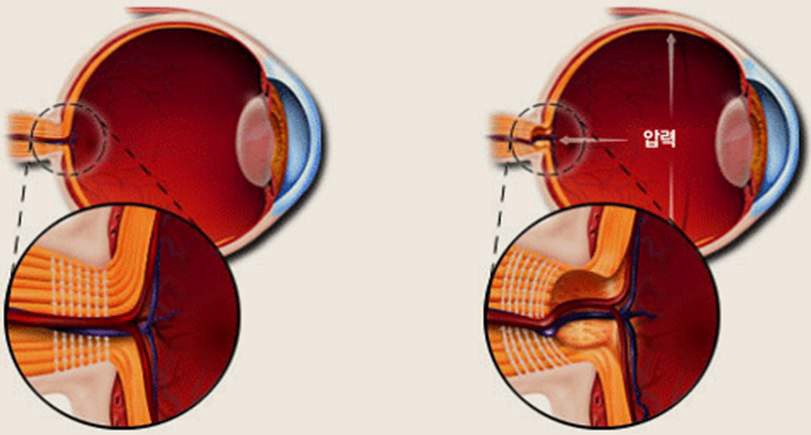 그림 12. 녹내장: 방수 균형의 이상으로 안압이 상승하여 신경에 압력이 가해짐