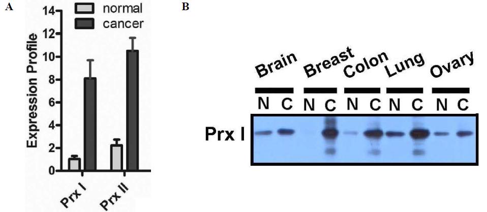 (A) Predominant Expressions of Prx I mRNA in Breast Cancer Tissue. Data show the transcript levels of Prx I. The BCRT II array (qRT-PCR) was used to determine the transcript levels of Prx I. Data were analyzed using the comparative CT method with the values normalized to β-actin level and expressed relative to controls. In parallel with each cDNA sample, standard curves were generated to correlate CT values using serial dilutions of the target gene. The y-axis represents the value of pg of DNA × 104. The BCRT II array consisted of five samples of normal breast tissue and 43 samples of breast cancer tissues from different individuals. Abbreviations: BCRT II, Human Breast Cancer qRT-PCR Array II. (B) Western Analysis of Prx I Protein Expressions in Malignant and Normal Tissues. Abbreviations: C, cancer (malignant); N, normal.