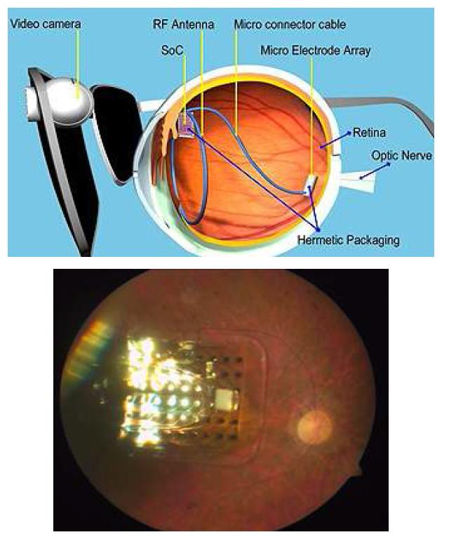 전기자극을 이용한 인공망막보철의 모식도 및 인체 삽입의 예