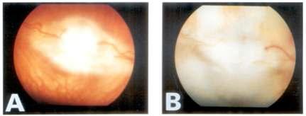 Optic nerve ischemia-reperfusion injury model