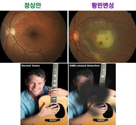 황반변성에 의한 시력저하 현상