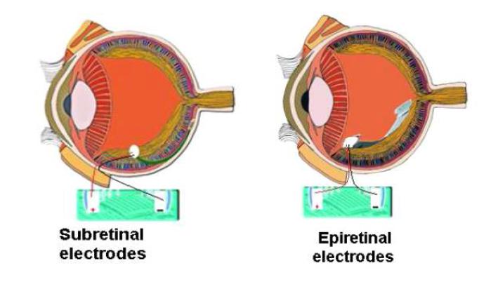 망막밑(sub-retinal) 자극과 망막앞 (epi-retinal) 자극