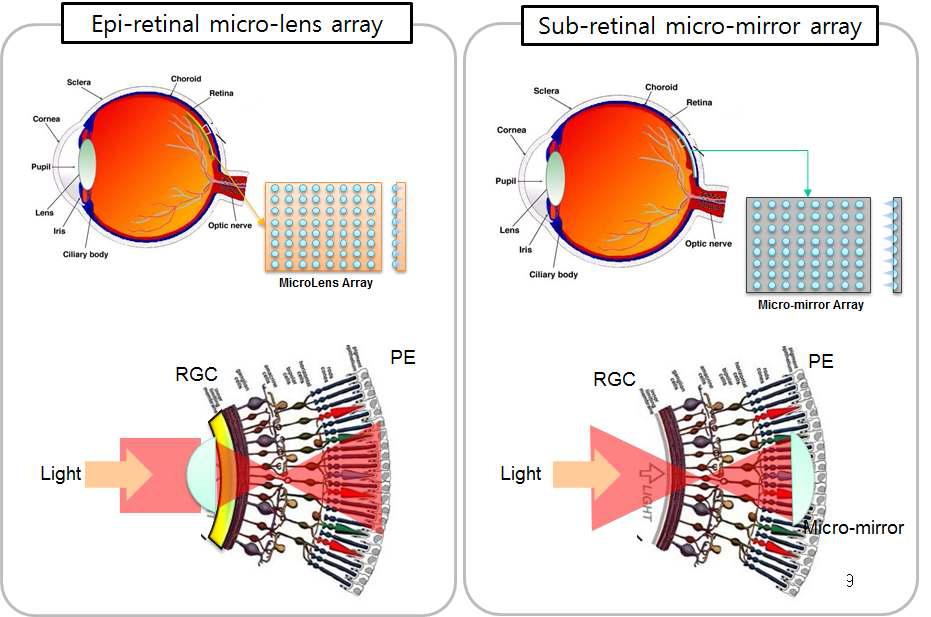 망막앞 마이크로렌즈 어레이와 망막밑 마이크로미러 어레이