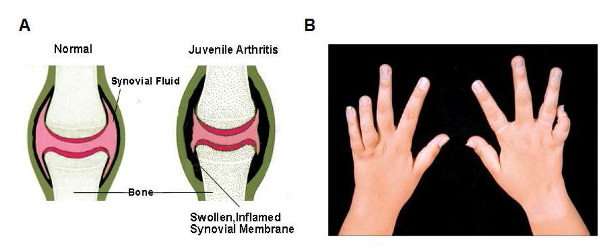 (A) 정상과 JRA 환자의 연골 모양 모식도 (B) JRA 환자의 손 모양 사진