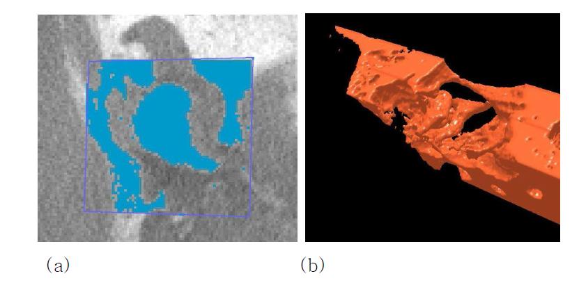 3D shape of the temporal bone reconstructed in 3D-Doctor software