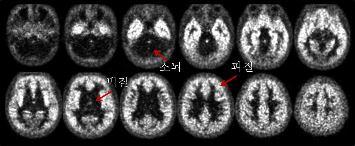 그림 80. [18F]FCWAY의 뇌 분포