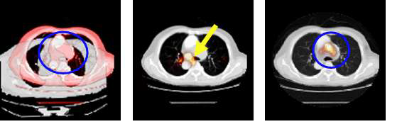 그림 93. 흉부위내 신체기관 및 종양조직의 위치와 크기를 평가를 위한 PET/CT와 외부CT영상의 정합