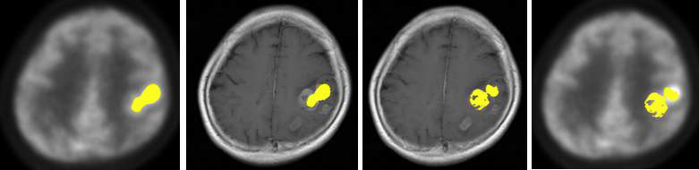 그림 94. PET과 MRI 두영상에서 각각 화소gradient를 이용하여 종양부위로 인식되어 추출된 영역