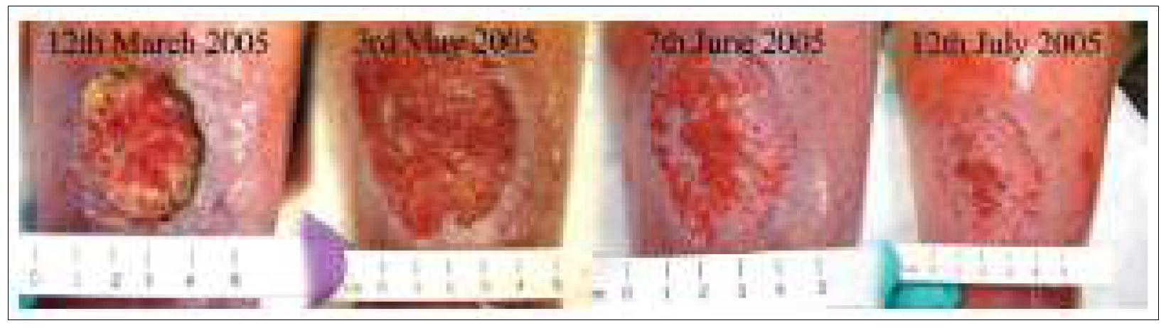 Fig. 97. Example of a successful phage therapy treatment. The patient was a 50 year old female with venous leg ulcers