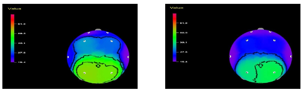 그림 10. 3차원 뇌 맵핑으로 보는 향 흡입 전과 흡입 중의 뇌파 변화 예시.