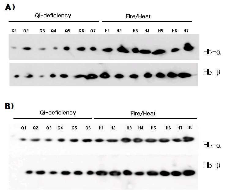 Plasma free hemoglobin alpha and beta expression between Qi-deficiency and Fire and heat group.