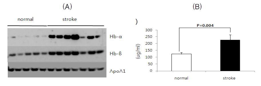 Hemoglobin level in plasma between normal and stroke patients