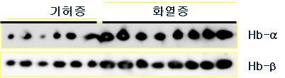 Different level of free hemoglobin alpha and beta on plasma between Qi-deficiency and Fire and heat group