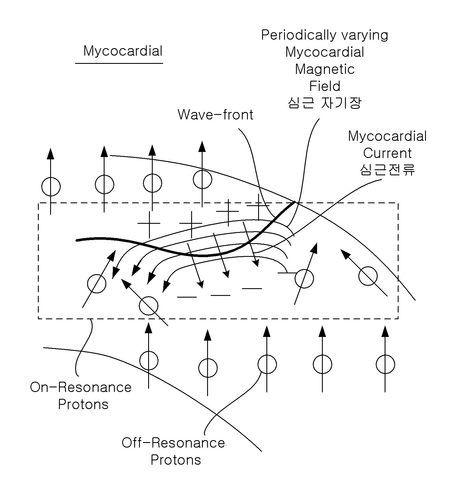 Principle of the heart magnetic resonance. The cyclic excitation of magnetic fields from myocardium resonates with protons near the reentry. Such magnetic resonance can be detected by a SQUID sensor.