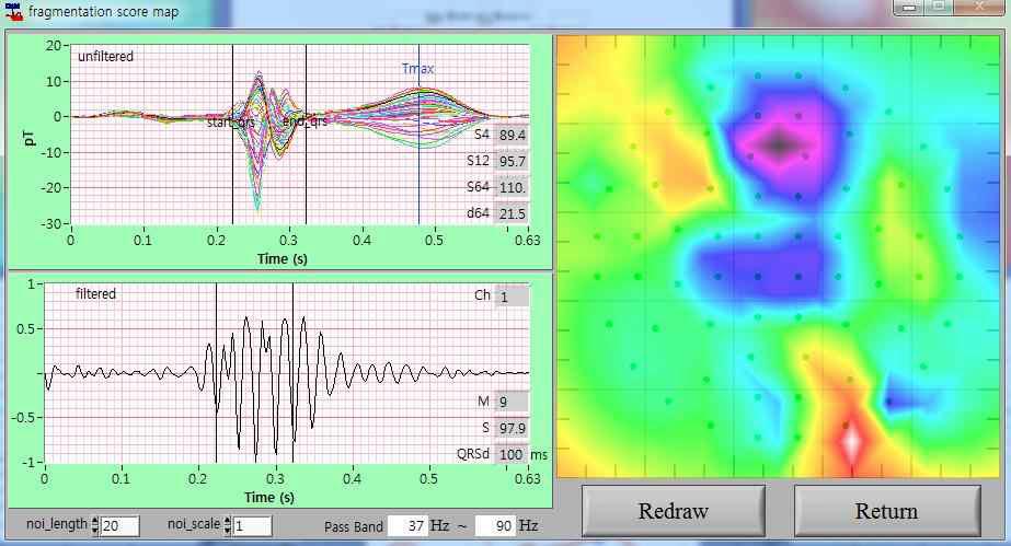 QRS Fragmentation score map