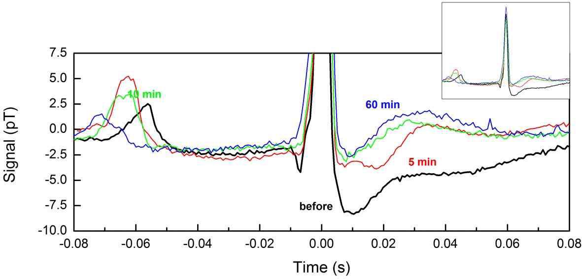 Temporal variations in the MCG waveforms of SHR injected with magnetic nano-particle fluid. Inset shows normalized overall MCG waveforms.