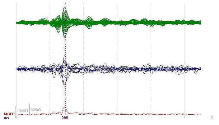 Butterfly plot of MEG and EEG signals.