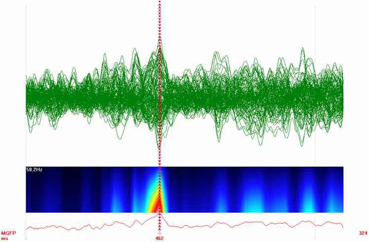 MEG butterfly plot and Spectra power(t) of CCL group