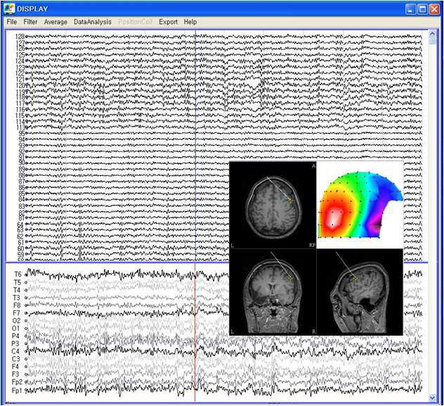 MEG and EEG display of epileptic patient, magnetic field map and dipole localization results at the specific time point.