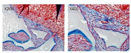 치근면(빨간색)에 부착되어있던 줄기세포는 모두 HA/TCP로 이동되어 cementum조직 재생(파란 색)을 유도하였다.