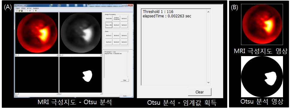 그림 34. Otsu 알고리즘을 이용한 MRI 영상내 심근경색 영역 표적화