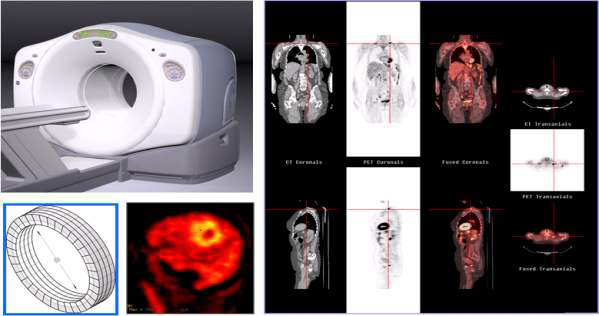 그림 6.2 PET/CT 장치(좌 : 위), PET 검출 및 영상(좌 : 아래), CT 영상 (우)