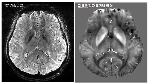 T2*가중영상(좌)과 자화율 정량화기법 영상(우)