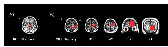 시상핵 (Thalamus)와 대뇌 피질간의 연결성을 확인하기 위해 T1 해부학적 영상 위에 설정한 ROI 도면들. A) Thalamus, B) 대뇌 피질