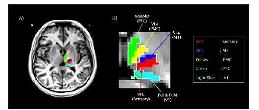 A) 시상핵과 서로 다른 기능을 담당하는 대뇌 피질의 각 영역간의연결성을 이용하여 시상핵을 세부 구조를 서로 다른 색을 지정하여 구분한 결과 영상과 B) 확대 영상