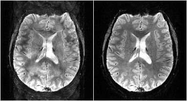 (좌) 일반적인 방법으로 재구성된 뇌 영상과 (우)amplitude correction을 추가하여 재구성된 뇌 영상