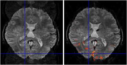(좌) 일반적인 방법으로 재구성된 fMRI와 (우) amplitudecorrection을 추가하여 재구성된 fMRI 결과의 뇌 활성 분포도