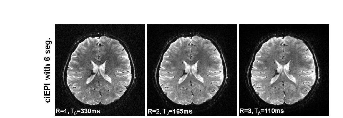 The images obtained by ciEPI schemes with 6 segments and R=1, 2 and 3