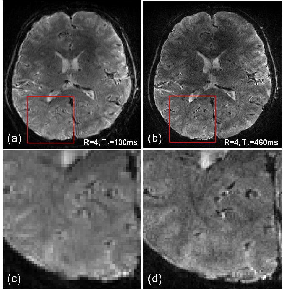 High resolution imaging using ciEPI schemes, inwhich images have (a) 1.0 mm and (b) 0.6 mm in-plane resolution.