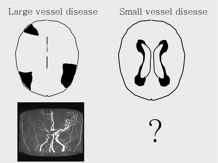 큰혈관 및 미세 혈관에 의한 장애 부위