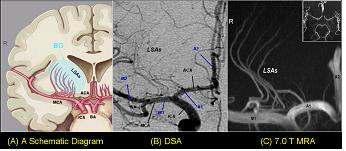 (A) 천공 동맥 (LSAs : Lenticulostriate arteries)의 해부학적 위치 (B) LSAs의 DSA 영상 (C) LSAs의 7.0 T MRA 영상