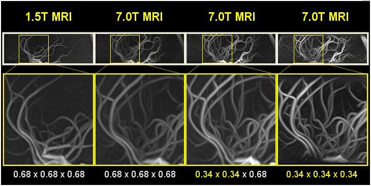영상 변수를 조절하여 공간 해상도를 높여서 시상면 (Sagittal view)에서 관측한 혈관 영상들과 그 확대 영상들)