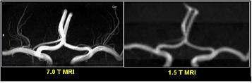 동일 인물의 LSAs를 각각 7.0 T MRI와 1.5 T MRI로 찍어서 관상면 (Coronal view)에서 본 미세한 뇌혈관 영상 비교