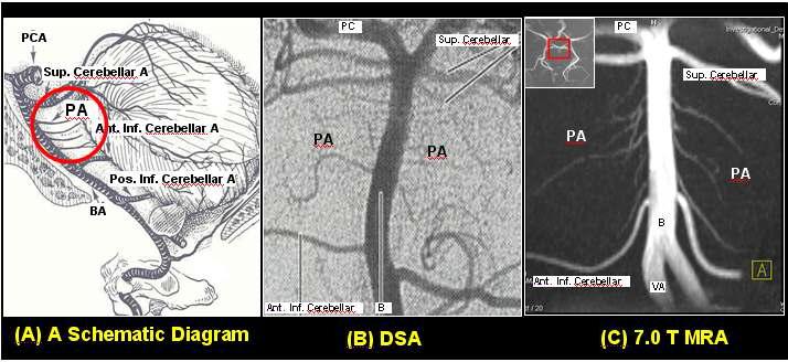 (A) 뇌교 동맥 (PA : Pontine Arteries) 해부학적 위치(B)PA 의 DSA 영상 (C) PA의 7.0 T MRA 영상