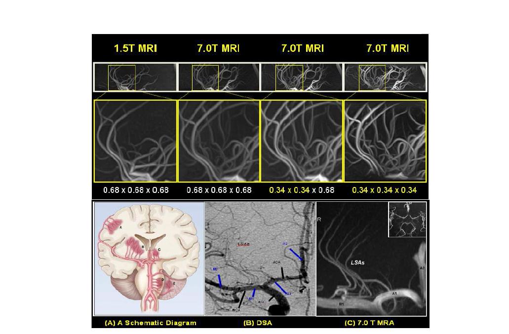 (위) 영상 변수를 조절하여 공간 해상도를 높여서 시상면에서 관측한혈관 영상들과 그 확대 영상들 (아래) 천공 동맥의 DSA 영상과 7.0T MRA 영상 비교 (Cho ZH , K ang, CK , et al., Stroke 2008)[3.34]