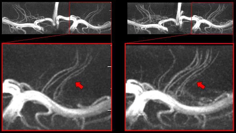 7.0T MRI를 이용한 미세혈관(천공동맥)의 조영제사용 전후 영상