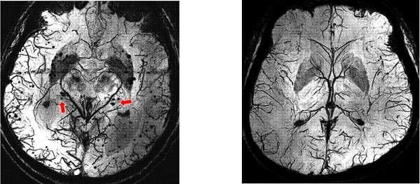 자화 강조 영상 (SWI): (좌)미세 혈관 질환 환자 및 (우)정상인