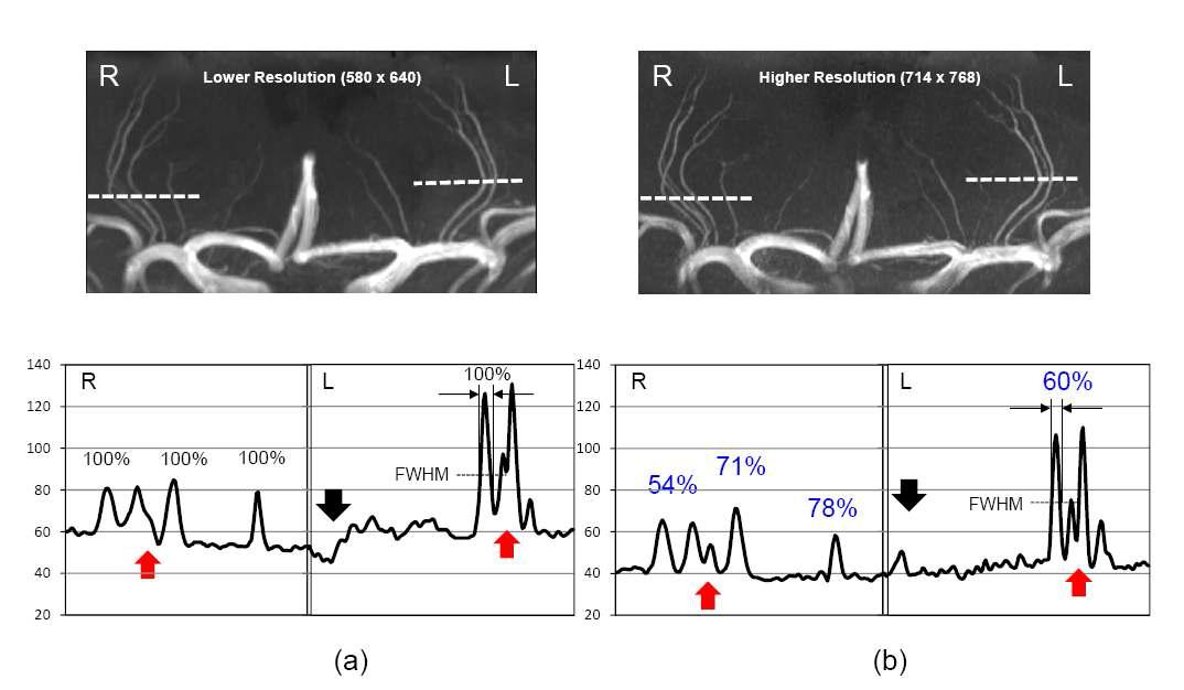 (위) 미세 혈관인 천공 동맥 영상과 (아래) 신호 프로파일 : (왼쪽) 저해상도 영상 (촬영시간: 4분) 과 (오른쪽) 고해상도 영상 (8분)