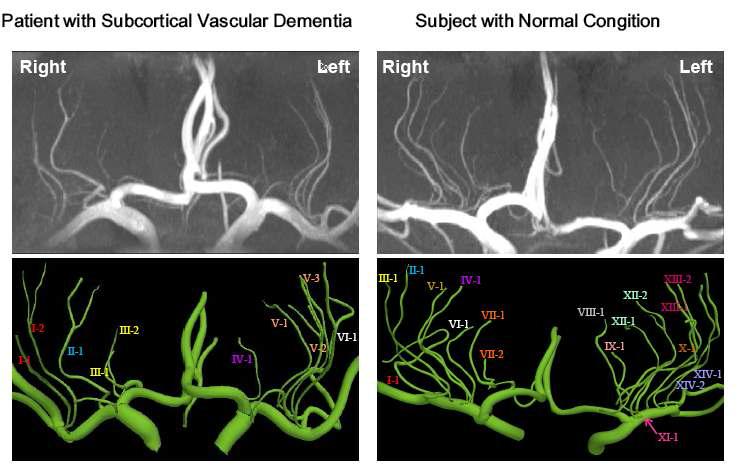 미세 혈관인 천공 동맥 영상 (위) 와 3D 모델링 결과 (아래): 미세 혈관 질환 환자 (왼쪽) 와 정상인 (오른쪽)