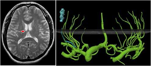 (좌) 해부학적 영상으로 나타난 뇌졸중 환자의 미세 뇌경색 부위 (우) 관련 미세 혈관인 천공 동맥과 뇌경색의 3차원 모델링