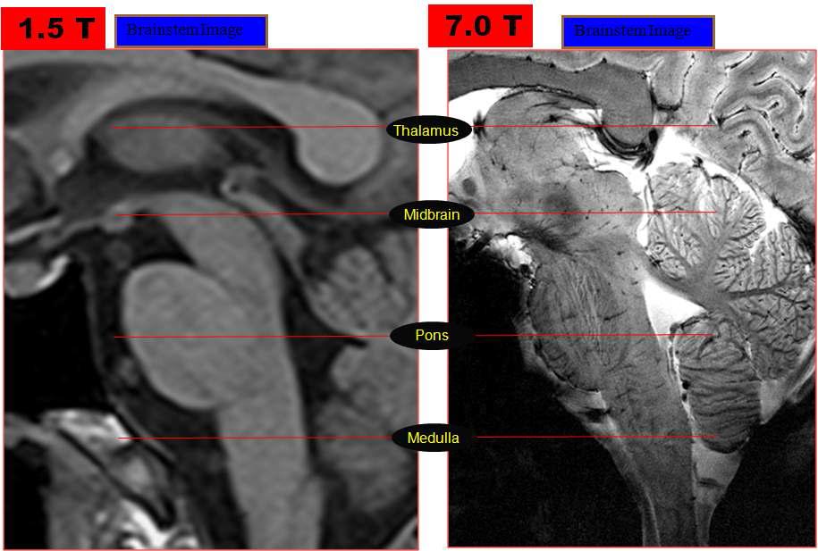 1.5T & 7.0T MRI에서 뇌간 (Brain stem) 영상 비교