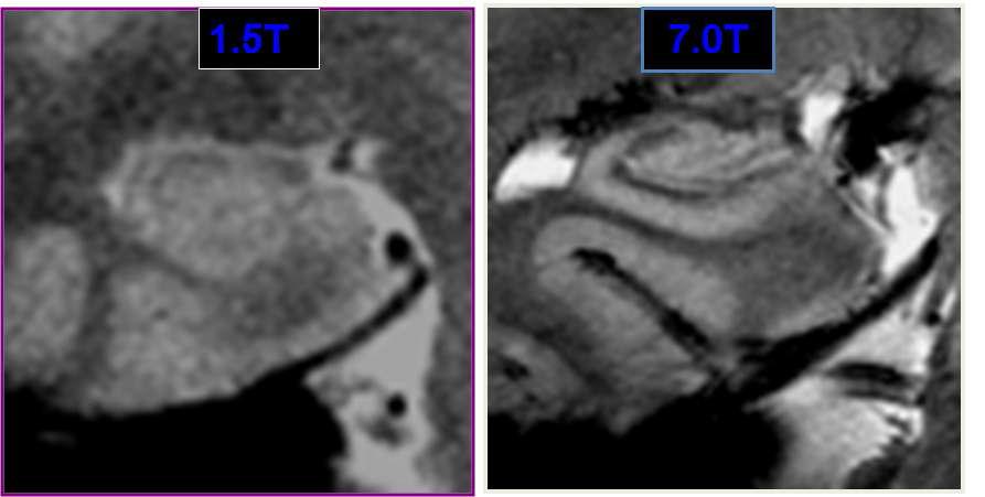 1.5T & 7.0T MRI에서 해마 영상 비교