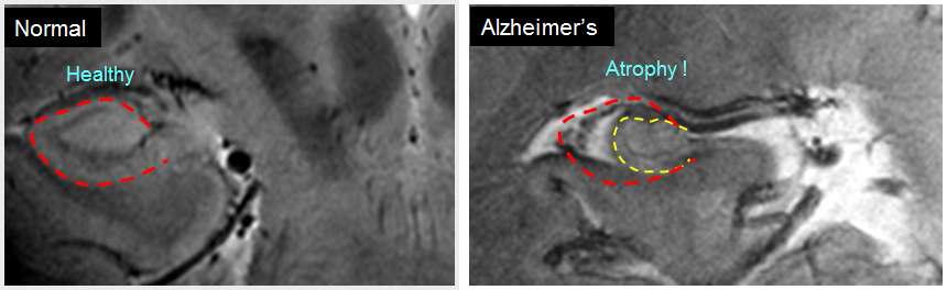 알츠하이머 질환을 가진 환자와 일반인의 해마 영상 비교