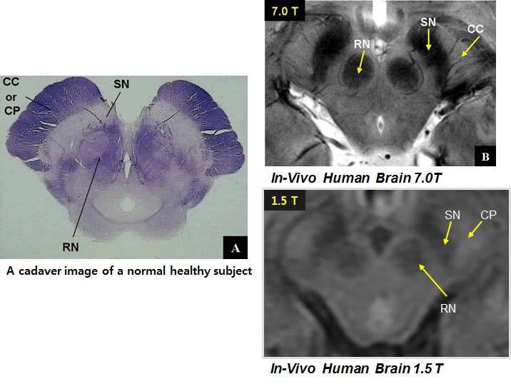 실제 생체조직의 구조와 1.5T & 7.0T MRI의 흑질 영상 비교